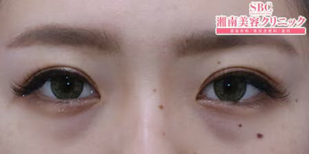 【女性・目元】週末二重(R)_aftar