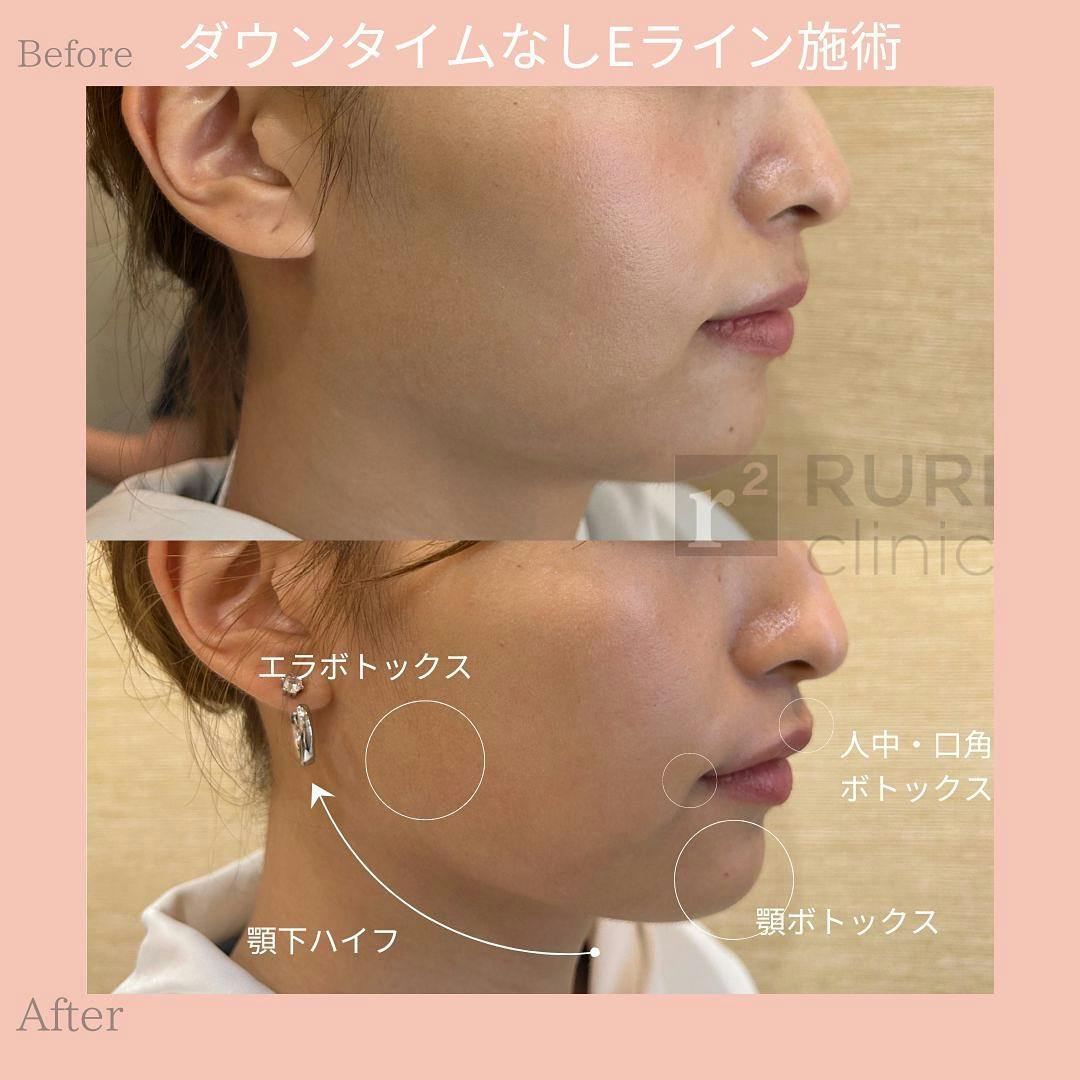 【女性・輪郭】ボトックス・ハイフ_before_aftar