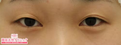 【女性・目元】腫れづらいスクエア二重術_before