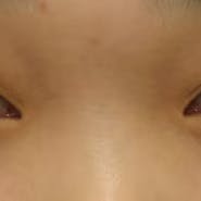 【女性・目元】腫れづらいスクエア二重術_before