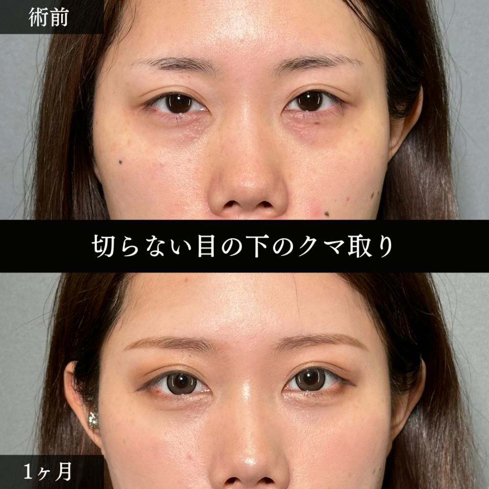 【20代女性・目】切らない目の下のクマ取り（経結膜脱脂術）_before_aftar