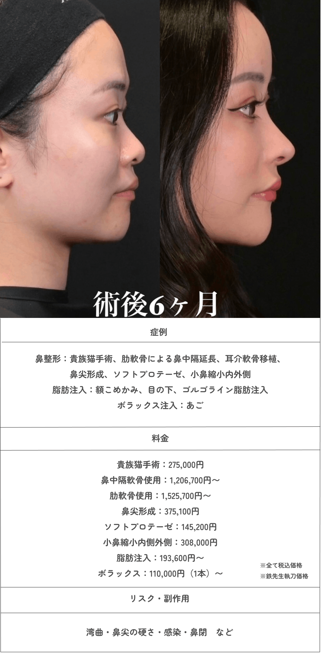 鼻整形　ジョン ドンハク　鉄 Zetith Beauty Clinic 鉄理事長による鼻整形の教科書が待望の第