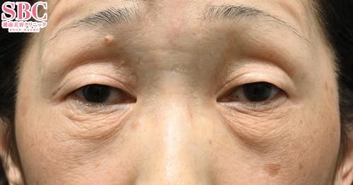 切開ハムラ(表ハムラ)法、ナチュラル脂肪注射ナノリッチ_before