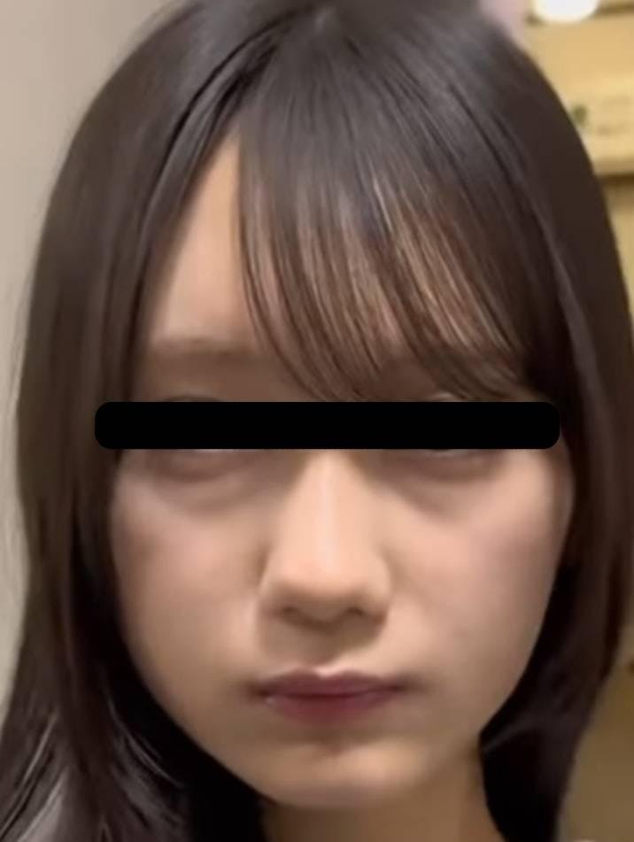 ルラ美容クリニック 渋谷本院で目の下のふくらみ取り：目の下のふくらみ取りスタンダードを受けたうちやまさんの写真