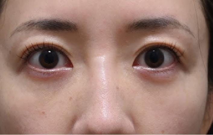 湘南美容クリニック 品川院でクマ取り：目の下の切らないクマ取り・たるみ（ふくらみ）取りを受けたぽんさんの写真