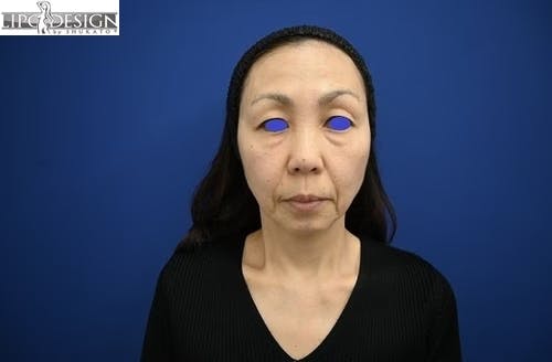 【52歳女性・輪郭】SBCプレミアムPRP皮膚再生療法、目の下の切らないクマ・たるみ（ふくらみ）取り_before