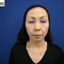 【52歳女性・輪郭】SBCプレミアムPRP皮膚再生療法、目の下の切らないクマ・たるみ(ふくらみ)取り_before