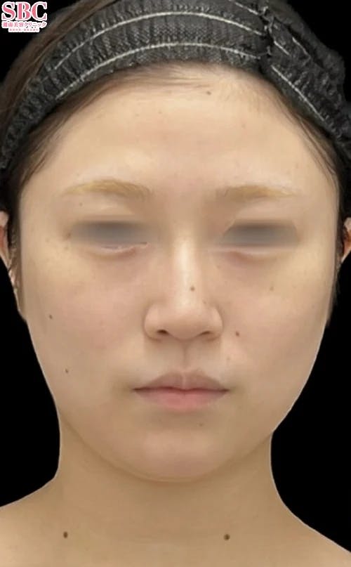 【20代女性・輪郭】プリマリフト_before