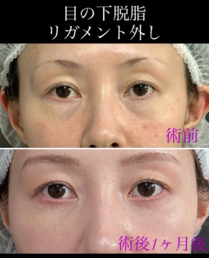 【女性・目元】目の下脱脂リガメント外し_before_aftar