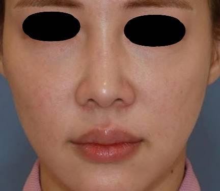 聖心美容クリニック 六本木院で鼻の整形：鼻中延長術・隆鼻術・貴族手術を受けたMAYUさんの写真
