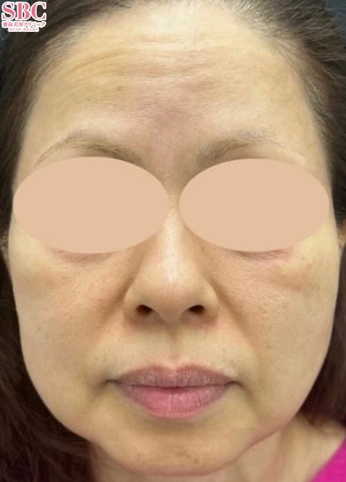 【50代女性・輪郭】VOV（ボブ）リフト・プリマリフト・ヒアルロン酸ジュビダームビスタ バイクロスシリーズ_before