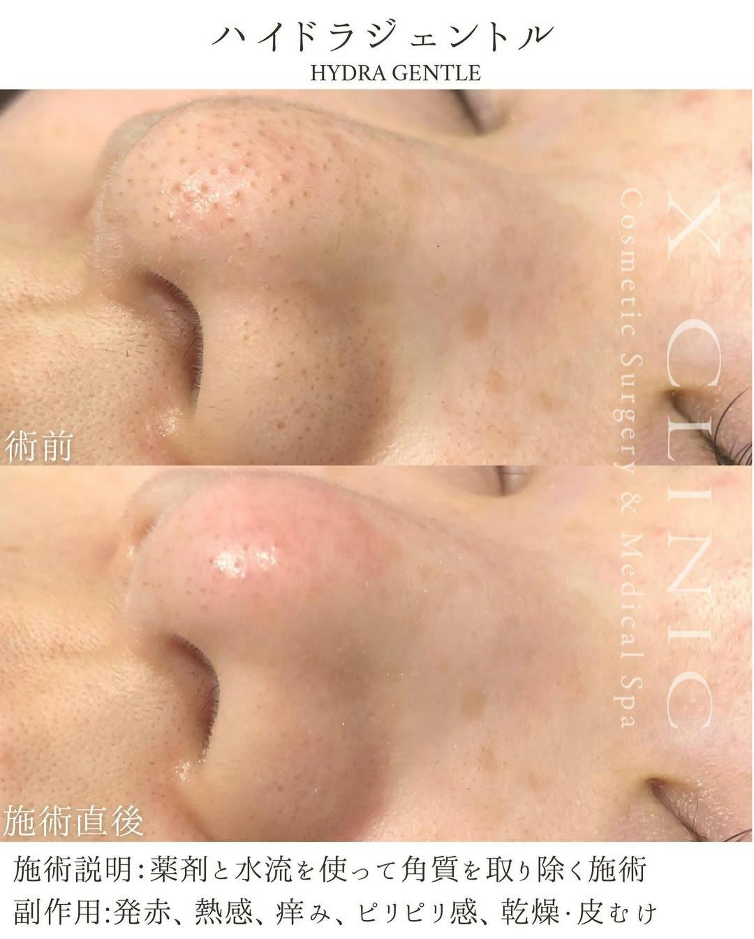 【女性・毛穴】ハイドラジェントル_before_aftar