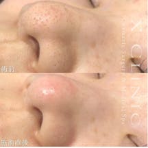 【女性・毛穴】ハイドラジェントル_before_aftar