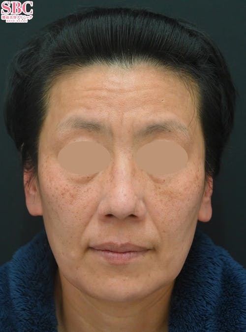 【女性・たるみ】ボトックス（アラガン）_before