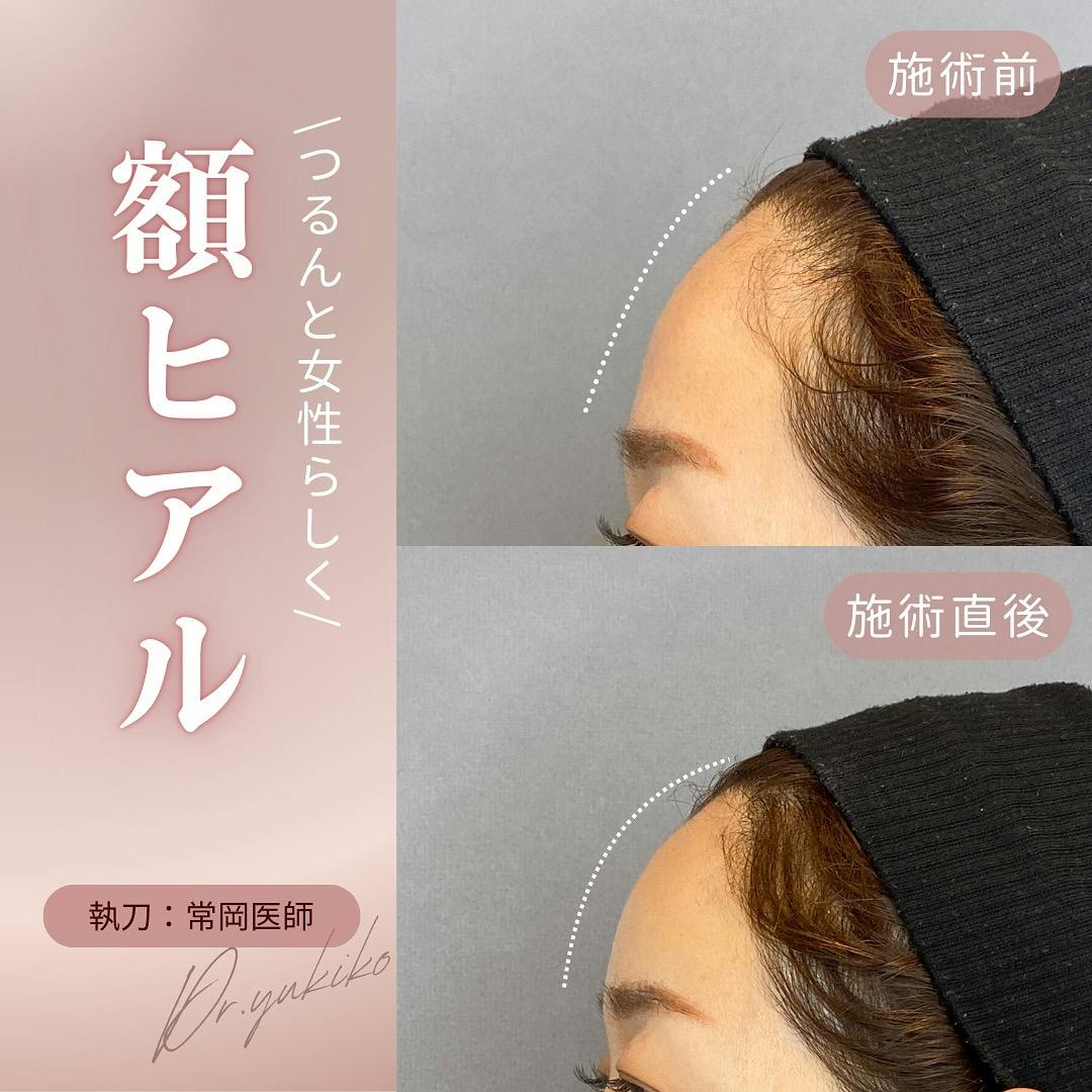 【女性・額】ヒアルロン酸注入_before_aftar