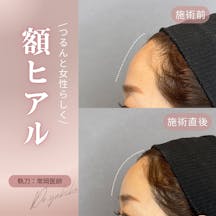 【女性・額】ヒアルロン酸注入_before_aftar