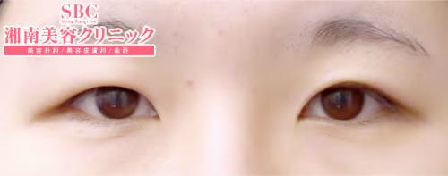 【女性・目元】クイックコスメティーク・ダブルNeo・自然癒着セット（上眼瞼脱脂）_before