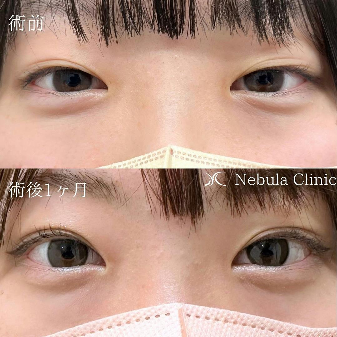 【女性・目元】二重埋没法_before_aftar