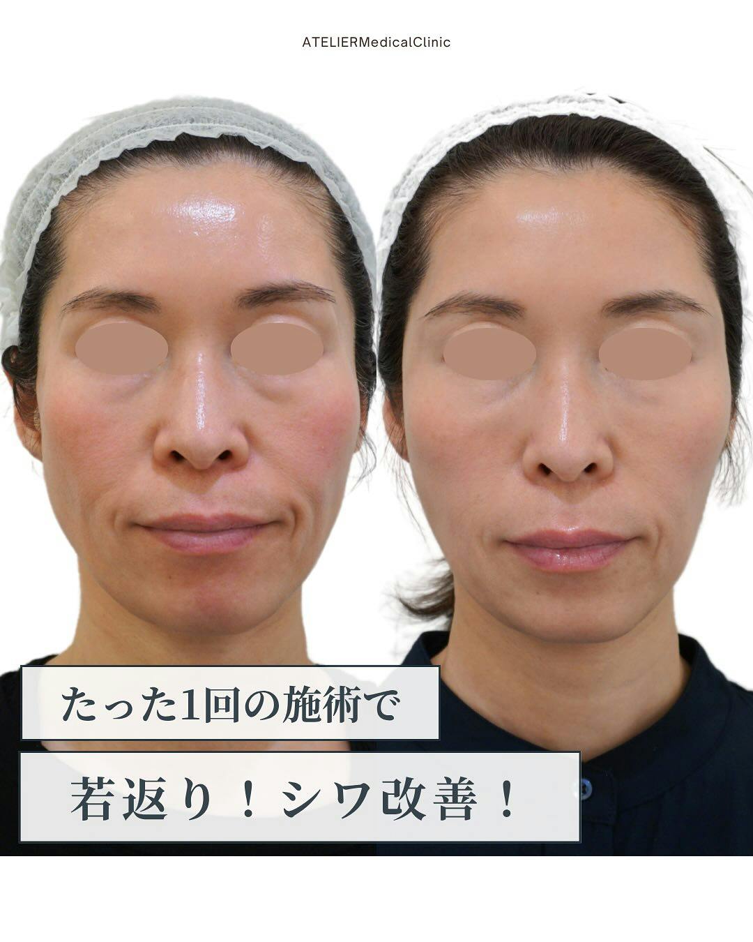 【女性・シワ】ヒアルロン酸 注入_before_aftar