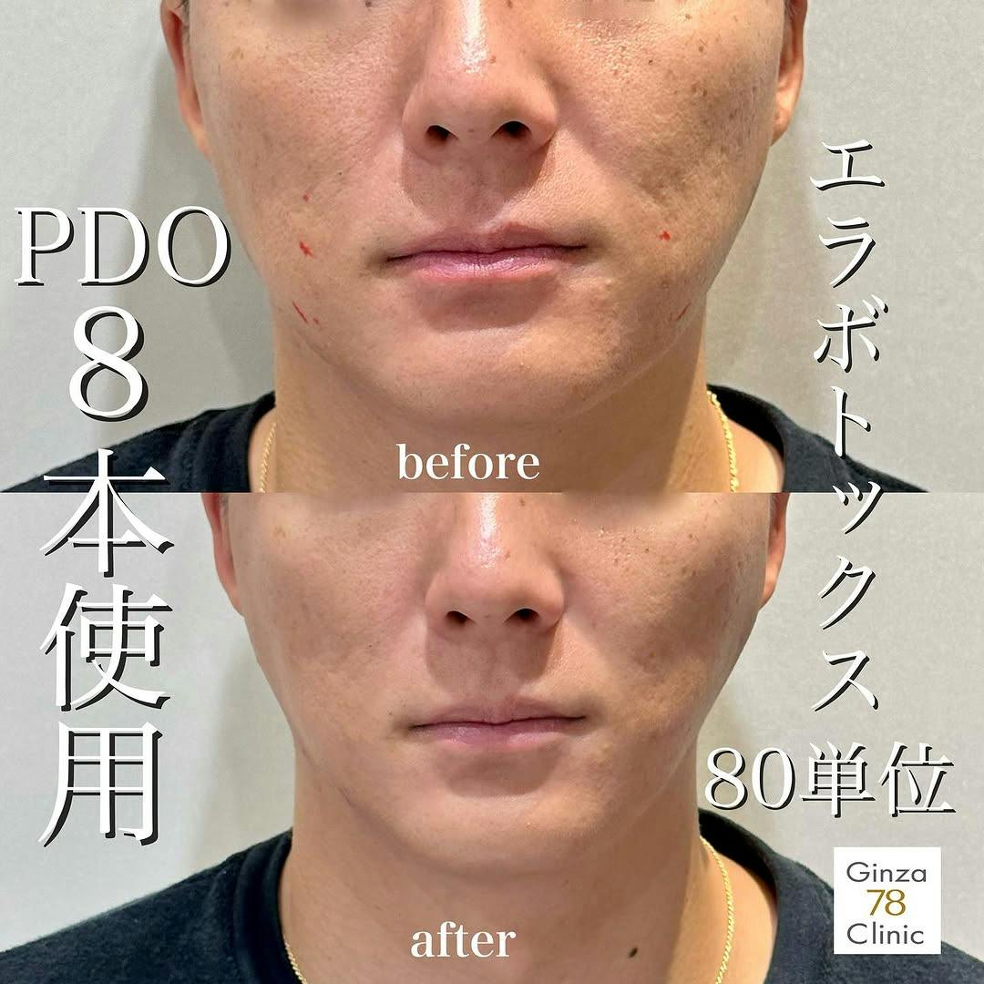 【男性・小顔】78式美肌小顔リフト エラボトックス_before_aftar