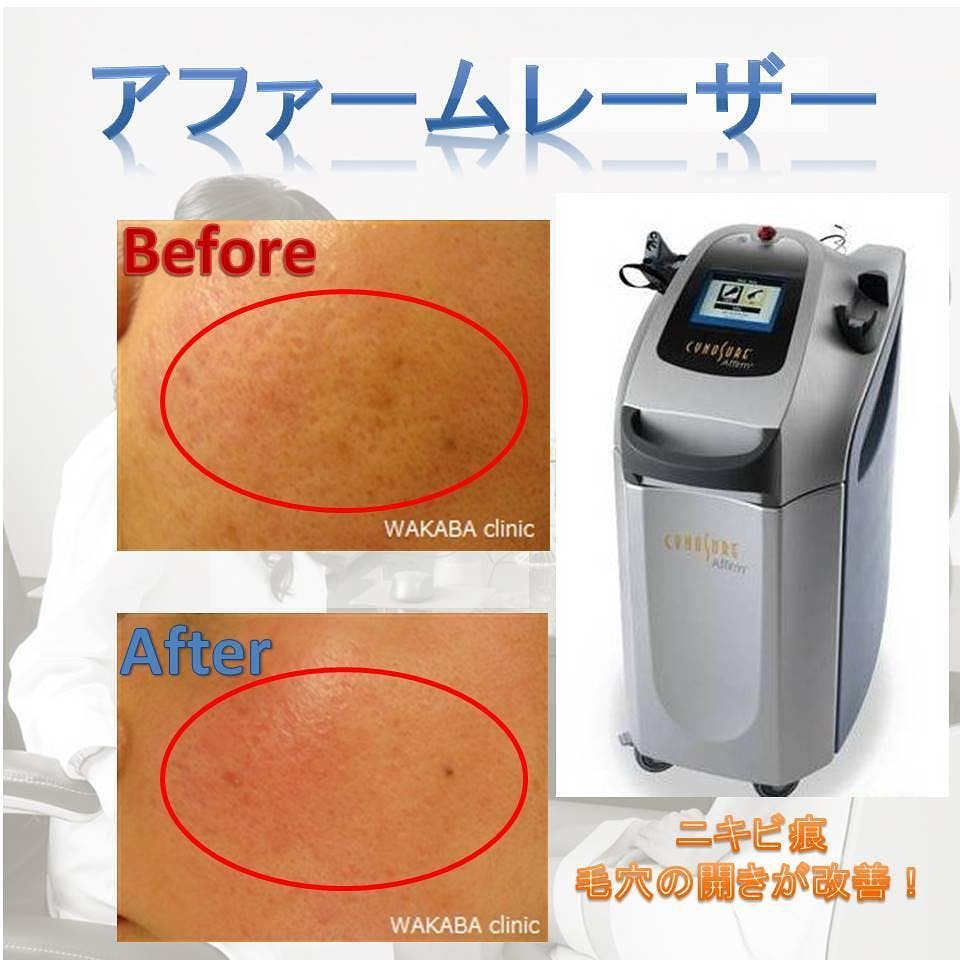 【ニキビ痕】アファームレーザー_before_aftar
