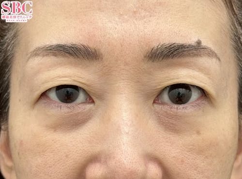 【女性・目元】眼瞼下垂＋二重_before