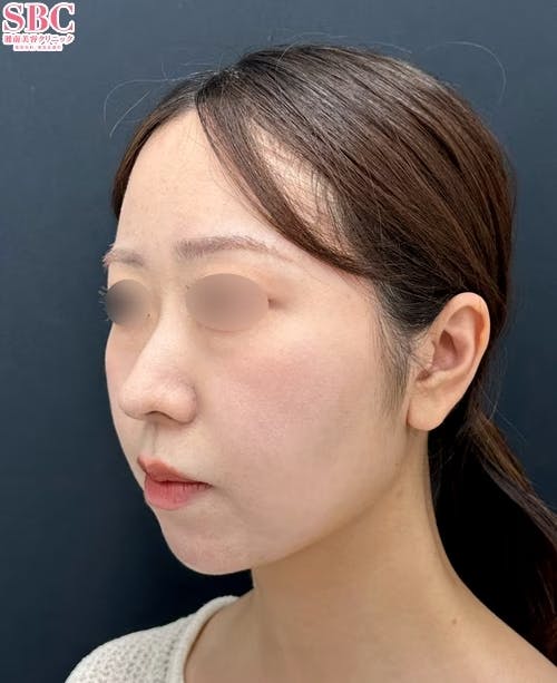 【20代女性・顔】メーラーファット除去術・ジョールファット除去術・Aquicell(アキーセル)脂肪吸引・糸リフト_after