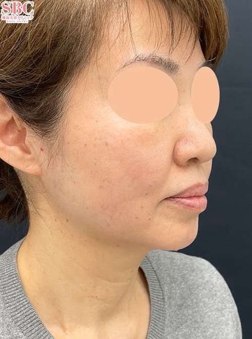 【女性・輪郭】Aquicell（アキーセル）脂肪吸引 メーラーファット除去術 ジョールファット除去術_aftar