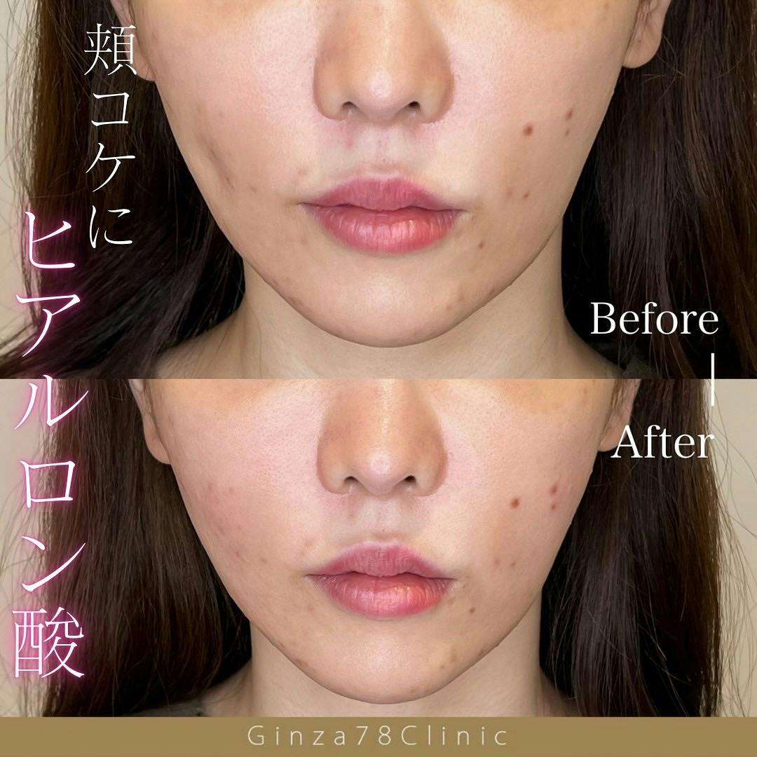 ヒアルロン酸注射・注入・ニューラミス・ジュビダーム(ヒアルロン酸