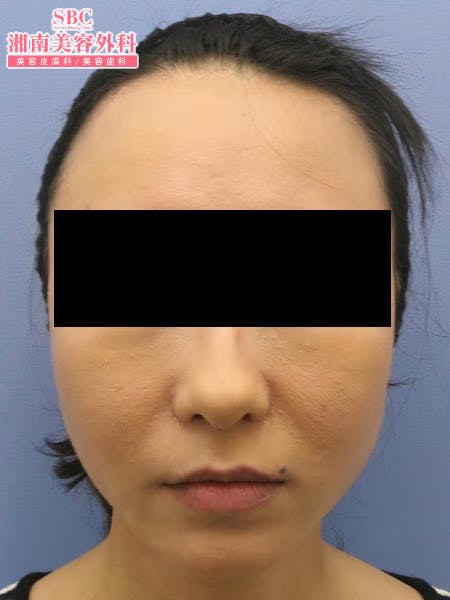 【女性・顔】根こそぎVASER脂肪吸引・ライポマティック脂肪吸引_aftar