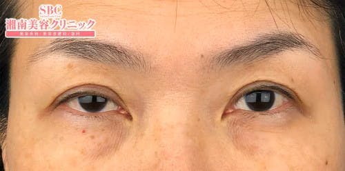 タルミ取り併用全切開法二重、眼瞼下垂 _before