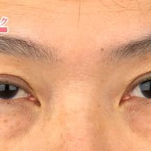 タルミ取り併用全切開法二重、眼瞼下垂 _before