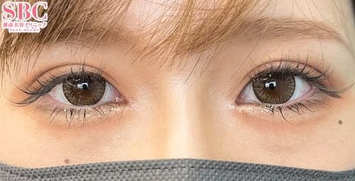 【女性・目元】クイックコスメティーク・ダブルNeo、目頭切開プレミアム、MD式切開法_after