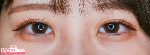 【女性・目元】クイックコスメティーク・シングルNeo、クイックコスメティーク・ダブルNeo_aftar