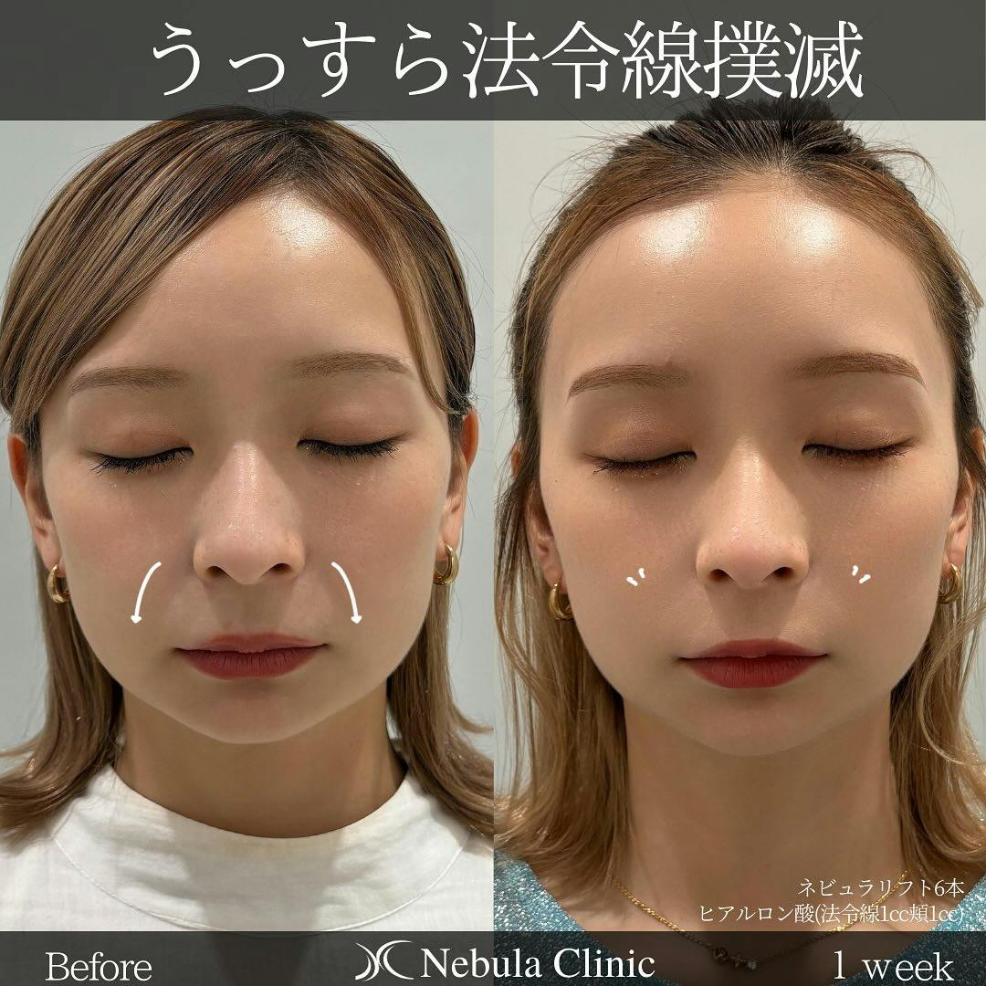 【女性・顔・法令線】糸リフト、ヒアルロン酸注入(法令線・頬)_before_aftar