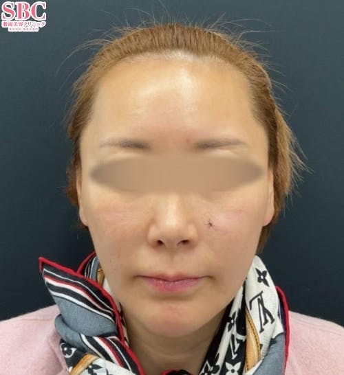 【40代女性・顔】プロファイロ_before