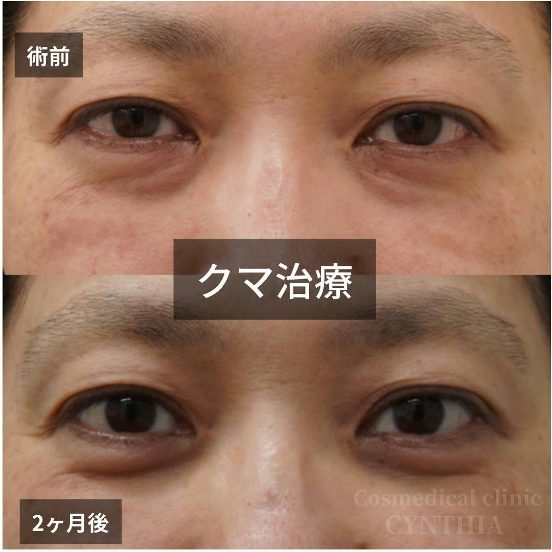 【50代女性・目元】目の下のクマ・たるみ取り_before_aftar