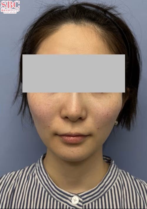 【女性・小顔】ヒアルロン酸ジュビダームビスタ バイクロスシリーズ_aftar