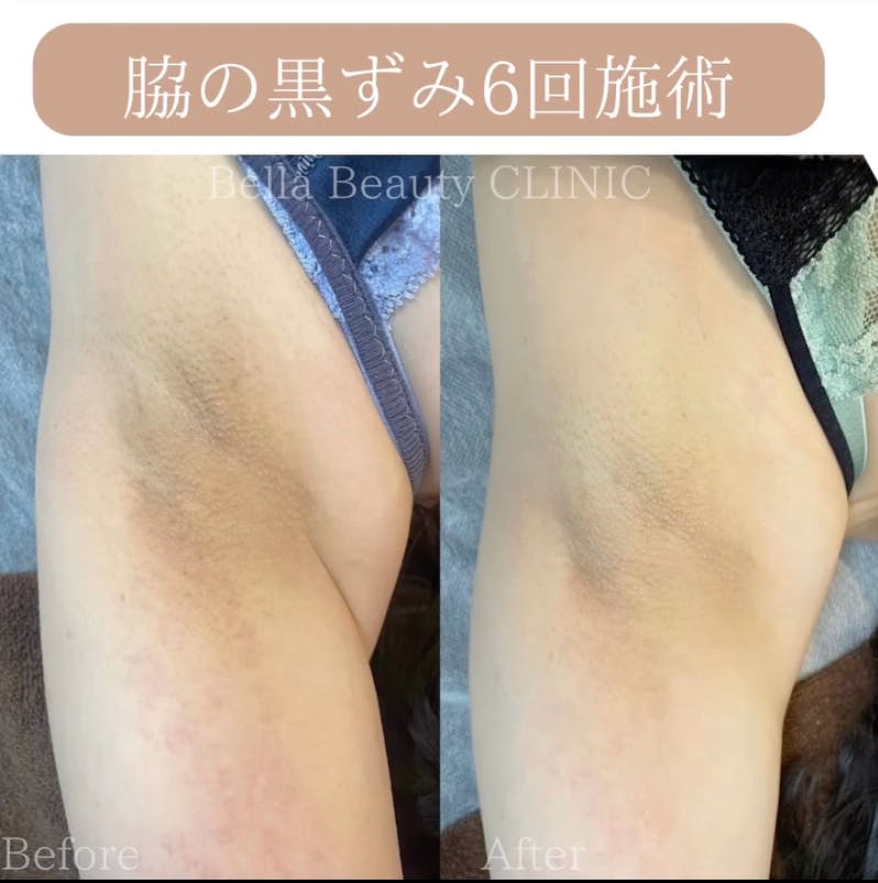 【女性・脇】脇黒ずみケアセット_before_aftar