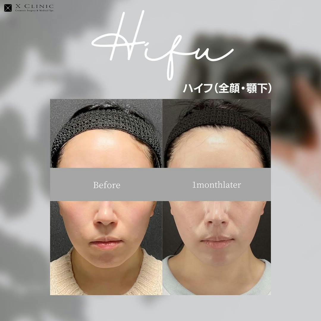 【女性・輪郭】ハイフ全顔・顎下コース_before_aftar