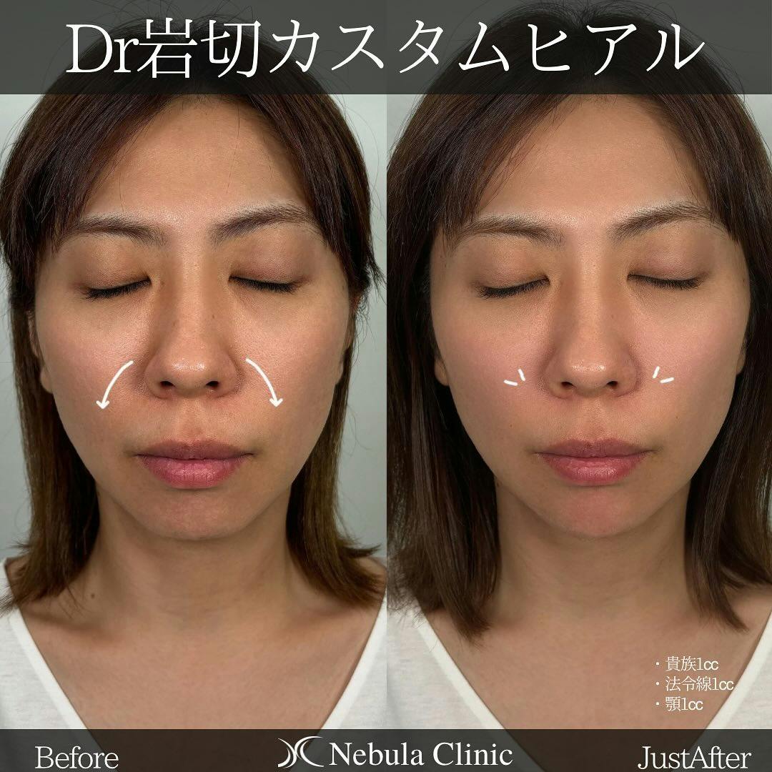 【女性・小鼻・法令線・顎】ヒアルロン酸注入(貴族・法令線・顎)_before_aftar