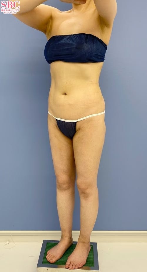 【女性・下半身】Aquicell（アキーセル）脂肪吸引、根こそぎVASER脂肪吸引_aftar