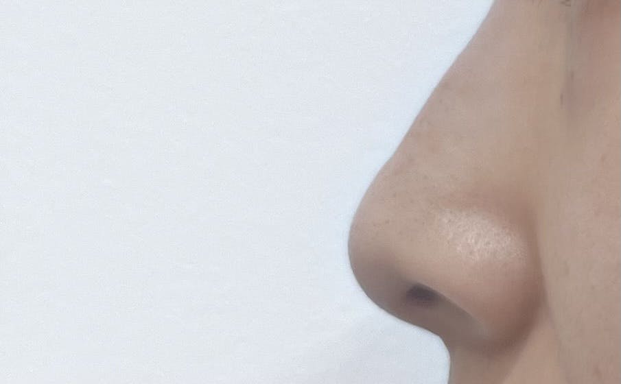 X CLINIC (エックスクリニック) 恵比寿院でヒアルロン酸注射・注入・ジュビダーム(ヒアルロン酸)・ボライトXC・ボリューマXC・ボリフトXC・ボルベラXC・ボラックスXCを受けたりりさんの写真