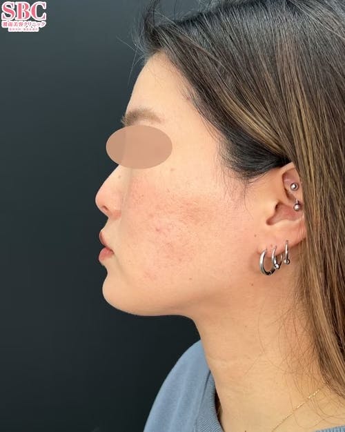 【女性・小顔】根こそぎVASER脂肪吸引_after