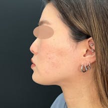 【女性・小顔】根こそぎVASER脂肪吸引_after