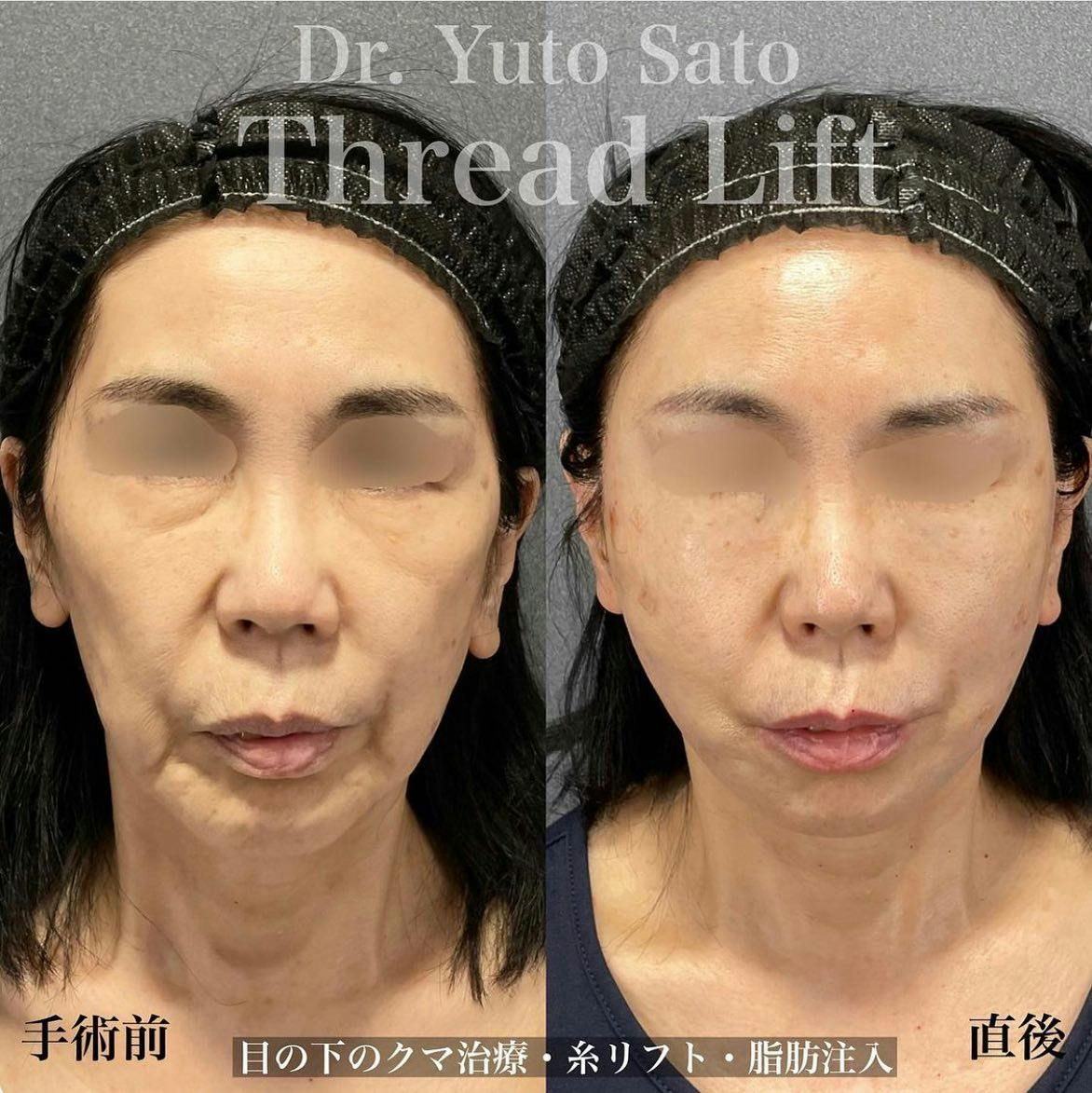 【女性・顔】糸リフト クマ取りフルコース 脂肪注入 ヒアルロン酸注入_before_aftar