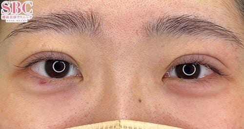 【20代女性・目元】クイックコスメティーク・ダブルNeo、ヒアルロン酸涙袋_justafter