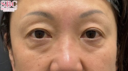 【50代女性・たるみ】目の下の切らないクマ・たるみ（ふくらみ）取り ナチュラル脂肪注射コンデンスリッチ ナチュラル脂肪注射ナノリッチ_before