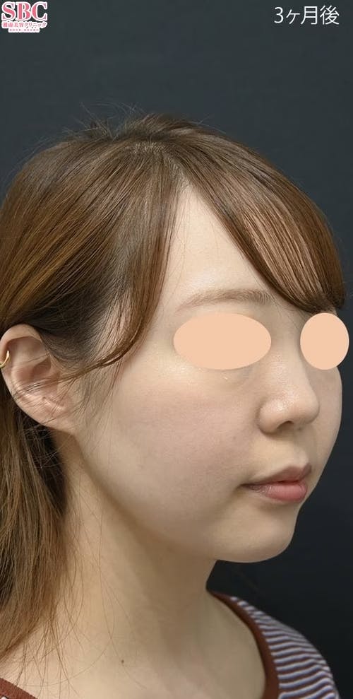 【20代女性・輪郭】根こそぎVASER脂肪吸引_after