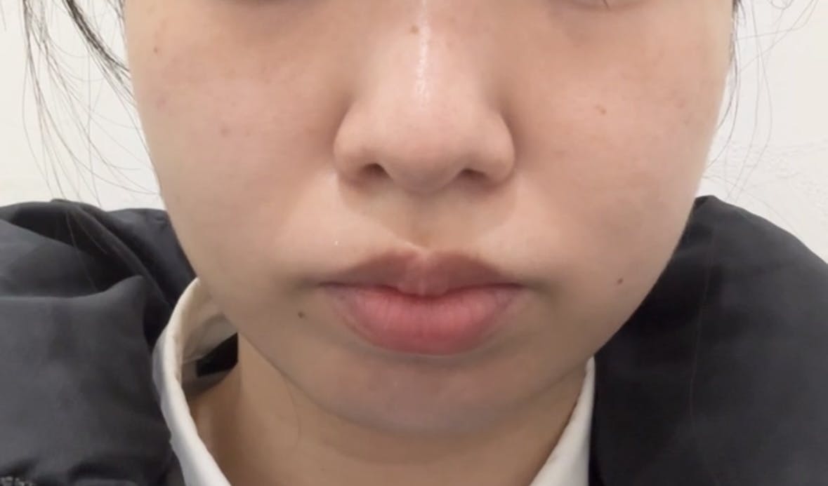 湘南美容クリニック 錦糸町院でIPL フォトダブルを受けたみなさんの写真